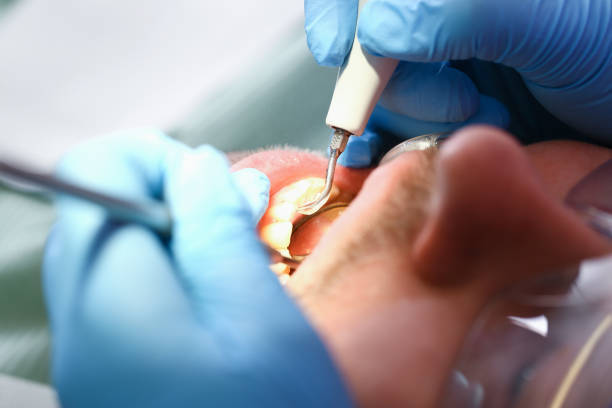 Best Emergency Treatment for Dental Infections or Abscesses in Galt, CA